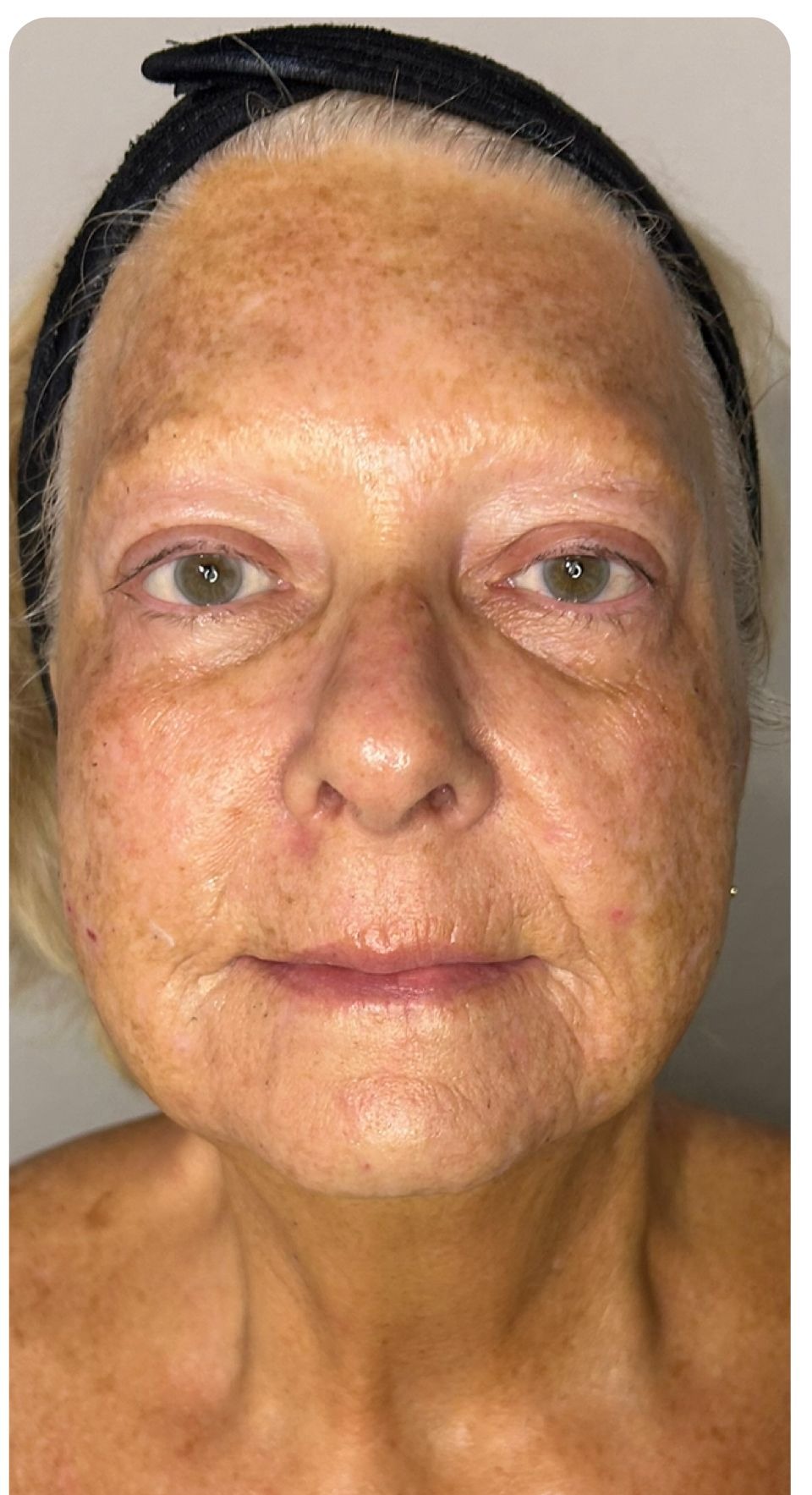 After treatment