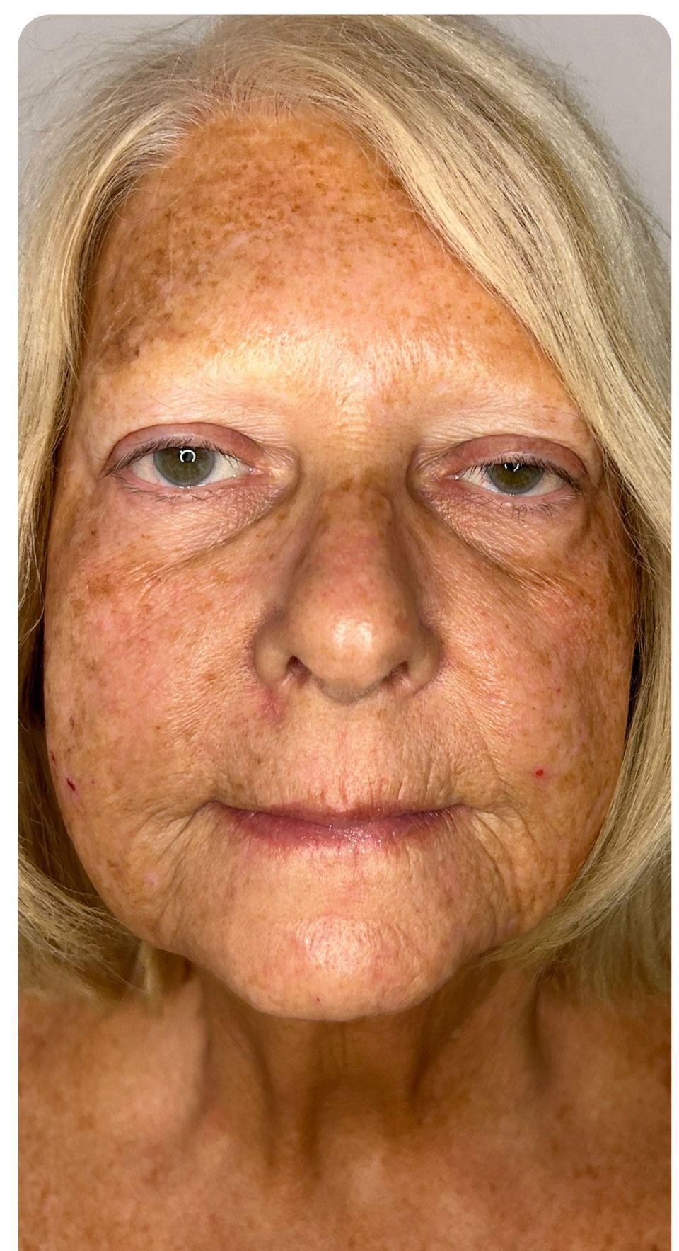 Before treatment